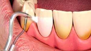 điều trị nha chu và cạo vôi răng tại phòng khám nha khoa răng hàm mặt Nha Khoa MIC Thủ Đức
