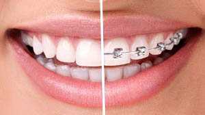 dịch vu đính đá trên răng tại phòng khám nha khoa MIC Thủ Đức