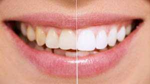 dịch vụ nha khoa tẩy trắng răng tại nha khoa MIC Thủ Đức