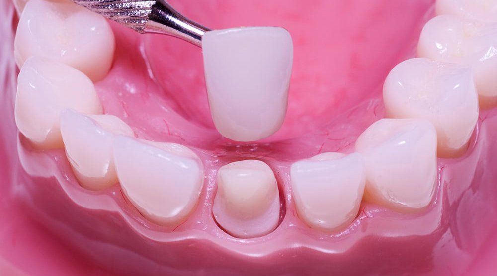 nên chọn loại răng sứ nào để tối ưu chi phí thực hiện