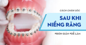 Cách Chăm Sóc Sau Khi Niềng Răng – Đơn Giản, Dễ Làm