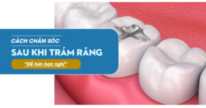 Cách Chăm Sóc Sau Khi Trám Răng – Dễ Hơn Bạn Nghĩ