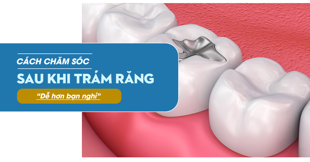 Cách Chăm Sóc Sau Khi Trám Răng – Dễ Hơn Bạn Nghĩ
