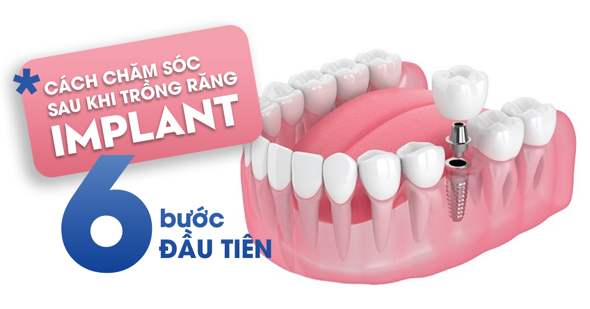 Cách Chăm Sóc Sau Khi Trồng Răng Implant – 6 Bước Đầu Tiên