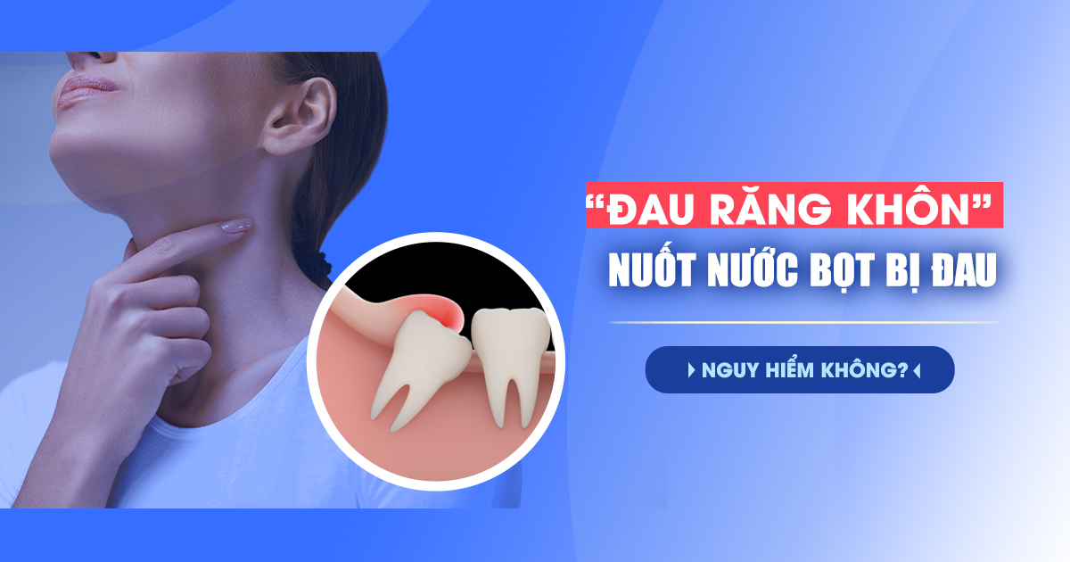 Đau Răng Khôn Nuốt Nước Bọt Đau: Khi Nào Nguy Hiểm