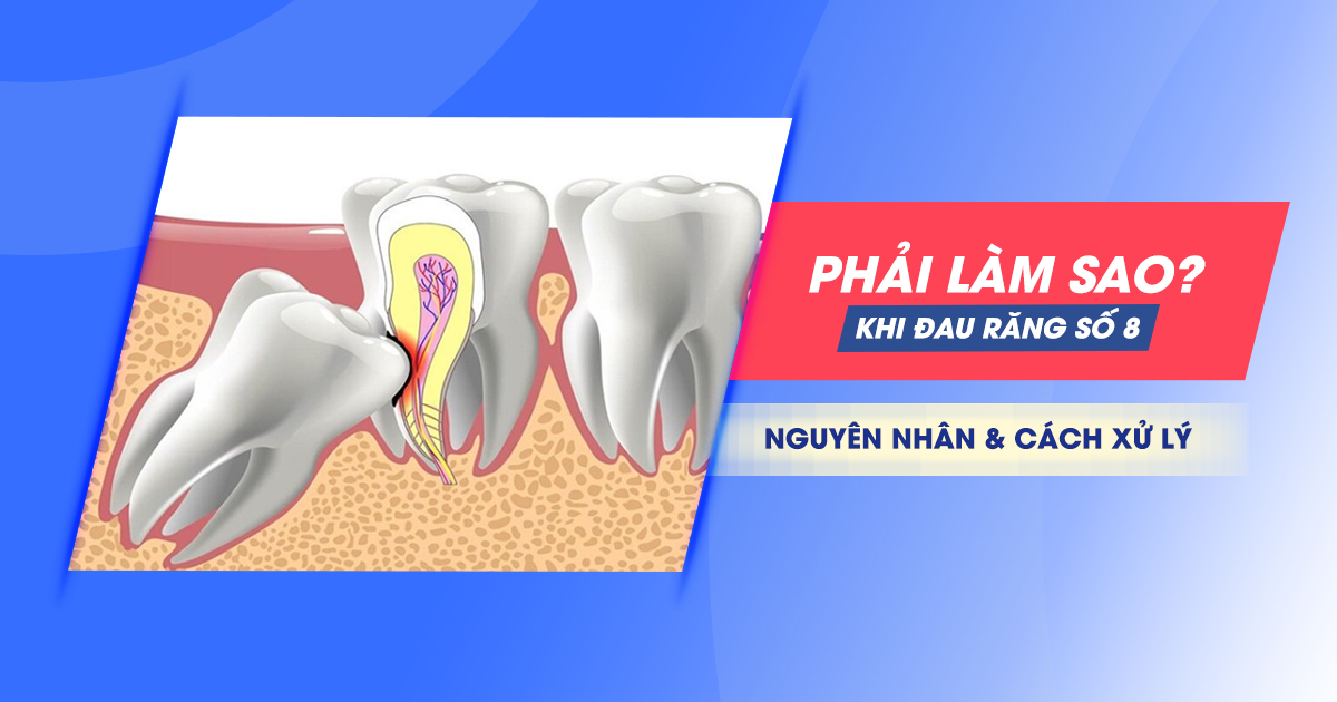 Đau Răng Số 8 Phải Làm Sao? Nguyên Nhân và Cách Xử Lý