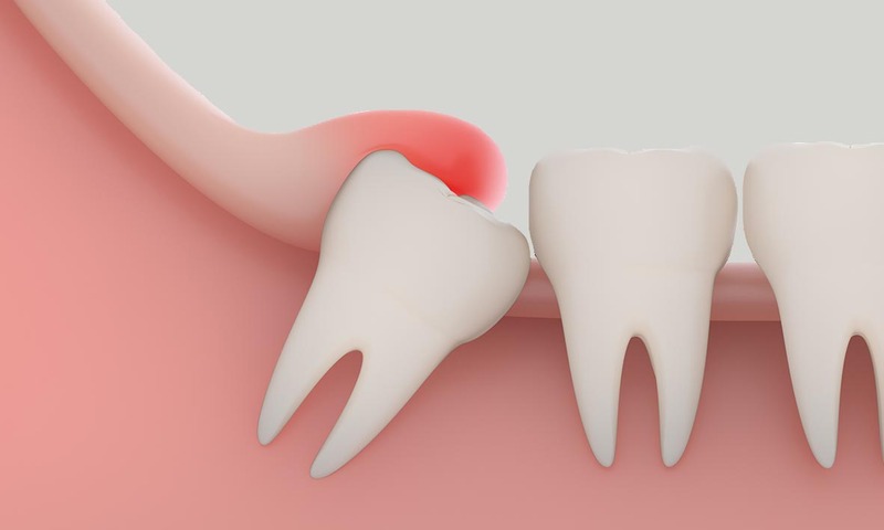Ai Cũng Phải Mọc Răng Khôn Hay Sao? Sự Thật Ít Ai Ngờ Tới!