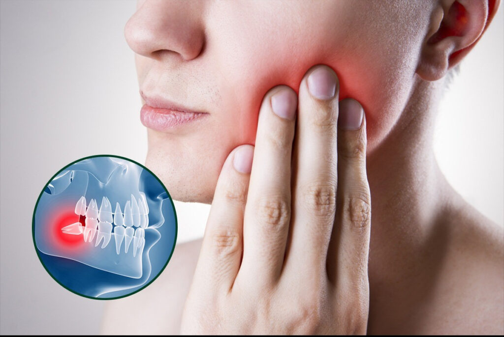 Răng khôn bị sâu phải làm sao? Cách xử lý hiệu quả