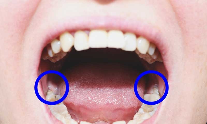 Răng khôn bị sâu phải làm sao? Cách xử lý hiệu quả