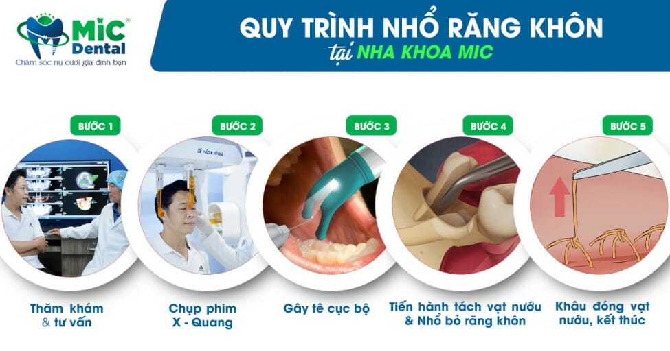 Đau Răng Khôn Nuốt Nước Bọt Đau: Khi Nào Nguy Hiểm