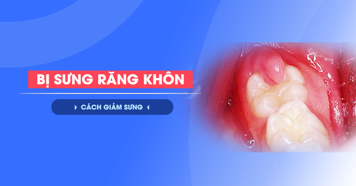 Bị Sưng Răng Khôn Nên Làm Gì? Cách Giảm Sưng Hiệu Quả