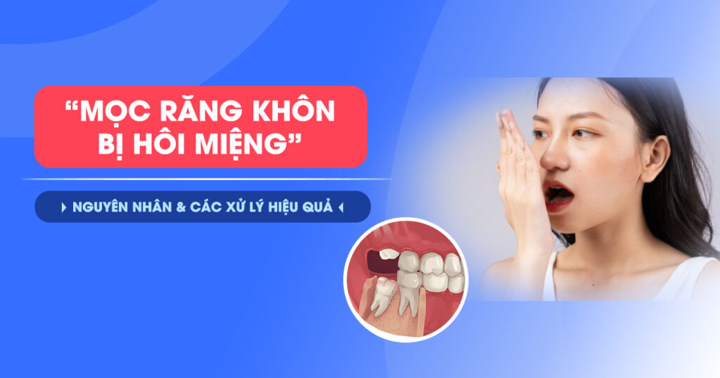 Mọc Răng Khôn Hôi Miệng: Nguyên Nhân và Cách Xử Lý Hiệu Quả