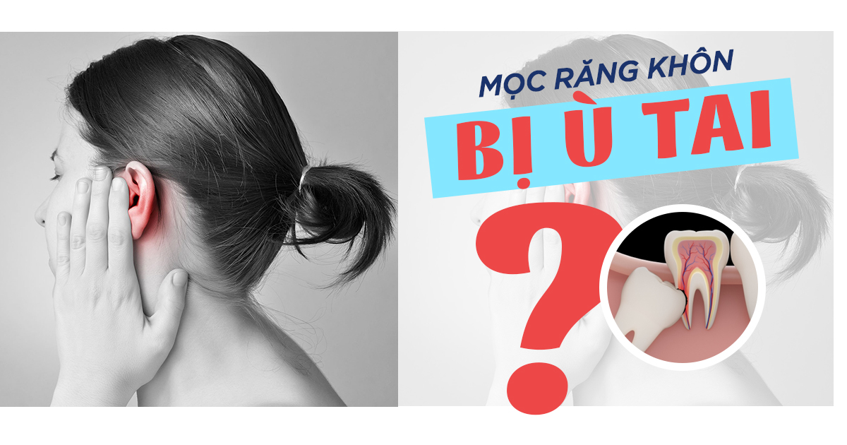 Mọc Răng Khôn Ù Tai: Dấu Hiệu Cảnh Báo Và Giải Pháp