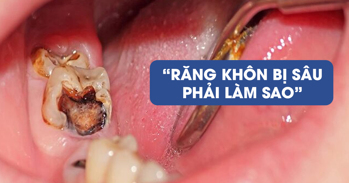 Răng khôn bị sâu phải làm sao? Cách xử lý hiệu quả