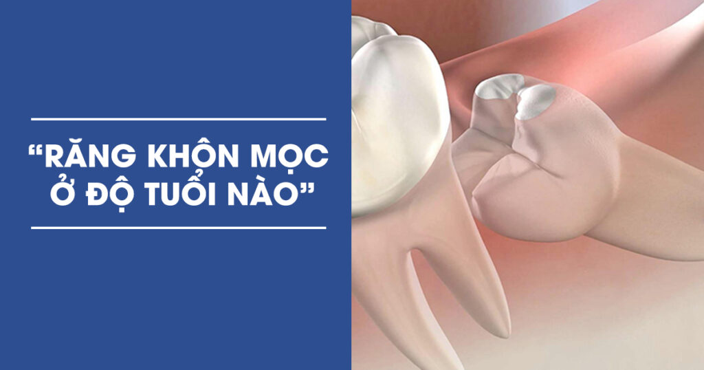 Răng Khôn Mọc Ở Độ Tuổi Bao Nhiêu? Có Phải Ai Cũng Mọc?