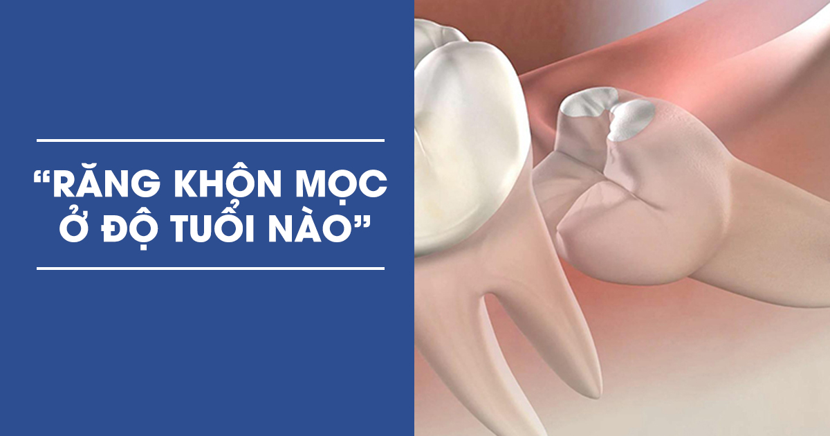 Răng Khôn Mọc Ở Độ Tuổi Bao Nhiêu? Có Phải Ai Cũng Mọc?