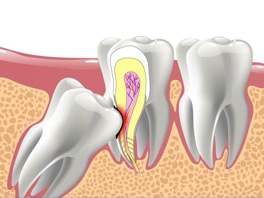 Mọc Răng Khôn Hôi Miệng: Nguyên Nhân và Cách Xử Lý Hiệu Quả