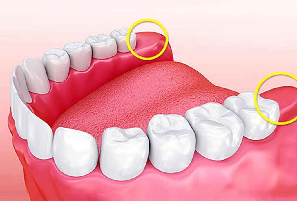 Răng Khôn Mọc Ở Độ Tuổi Bao Nhiêu? Có Phải Ai Cũng Mọc?